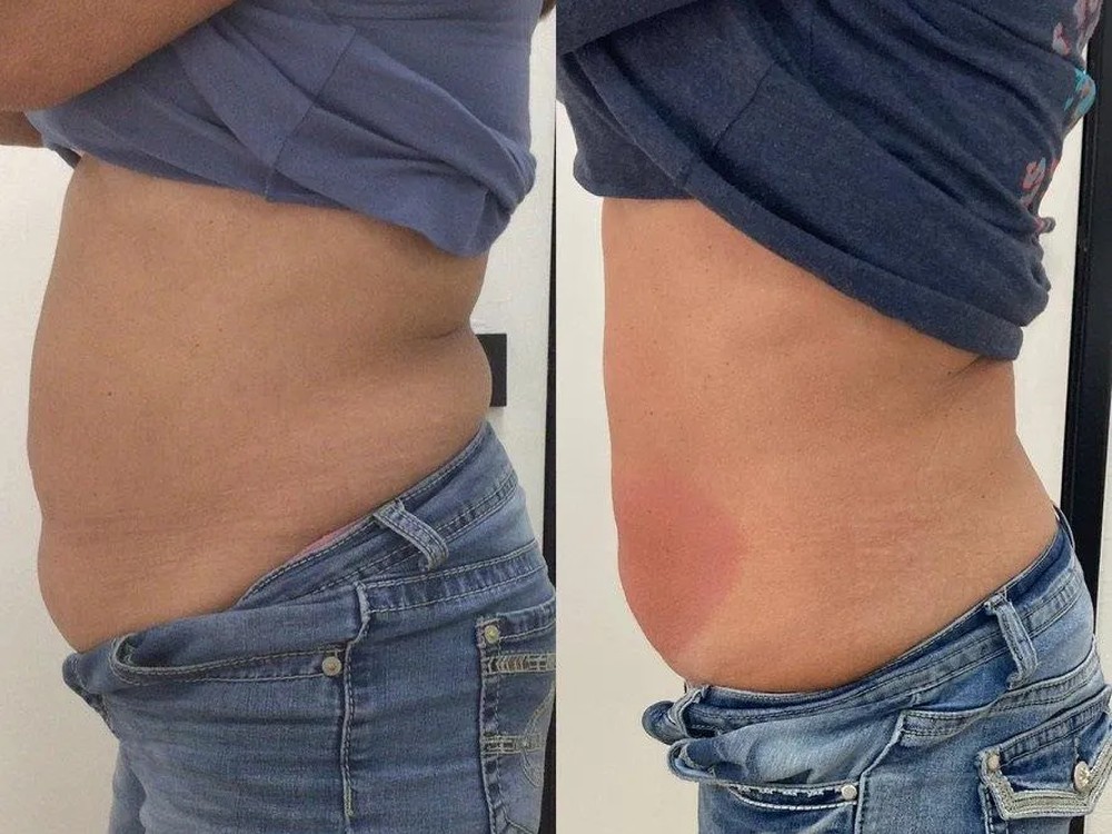 Body contouring before and after, side profile